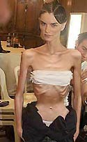 bulimia anorexia
